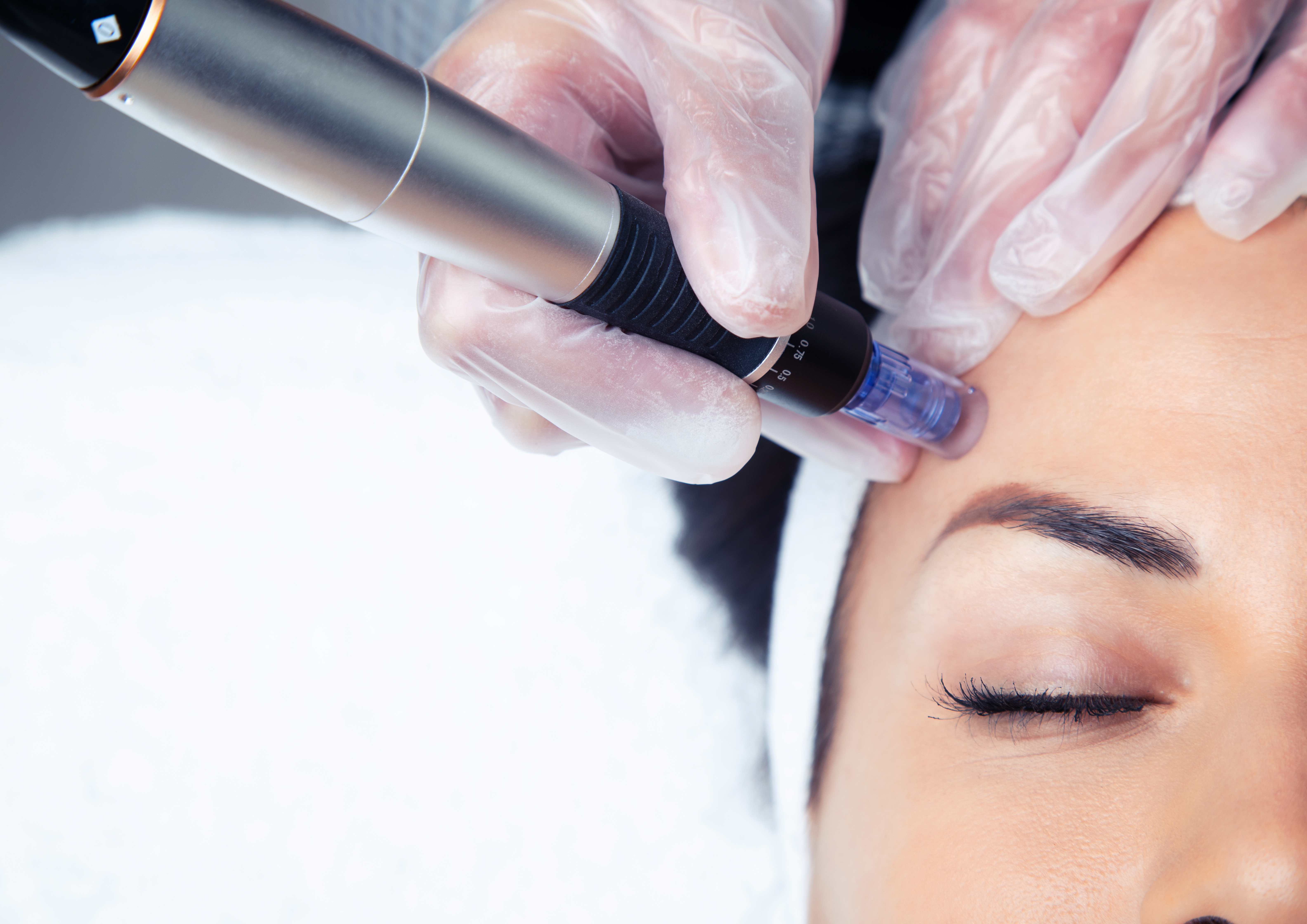 Exosomes Microneedling